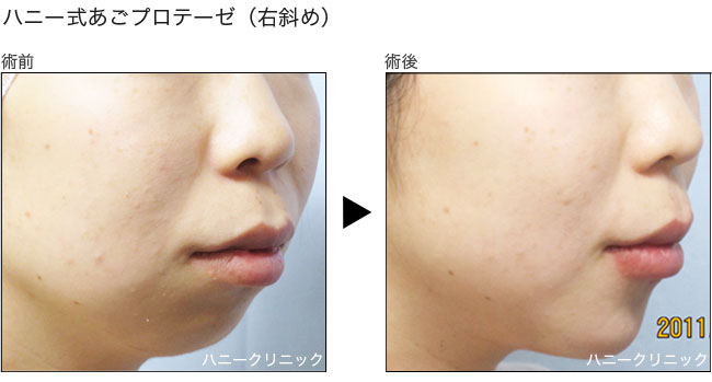 アゴプロテーゼ 熊本