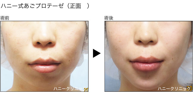 アゴプロテーゼ 熊本