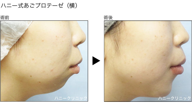 アゴプロテーゼ 熊本