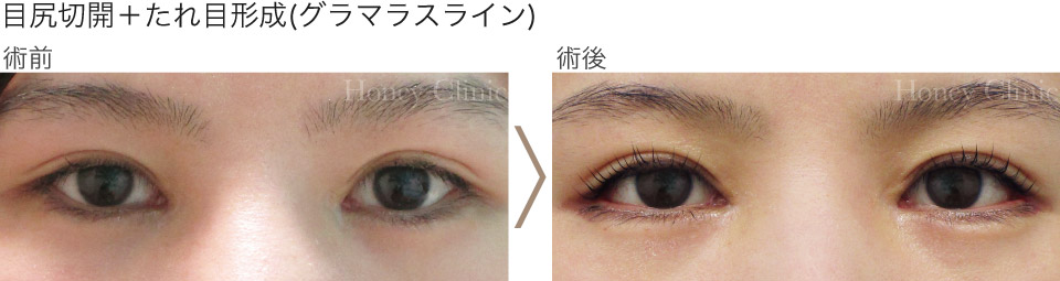 熊本で目頭切開法と切らない眼瞼下垂（目ヂカラアップ術）・グラマラスラインをするなら熊本のハニークリニックへ