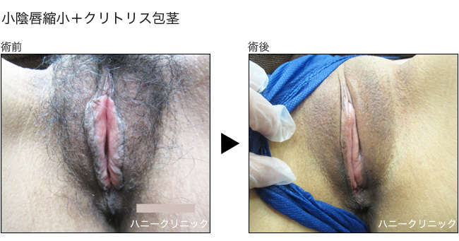 小陰唇縮小をするなら熊本の美容外科ハニークリニックへ