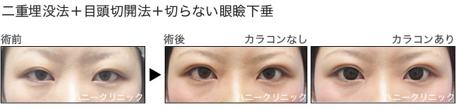 切らない眼瞼下垂と二重埋没法なら熊本の美容外科ハニークリニックへ