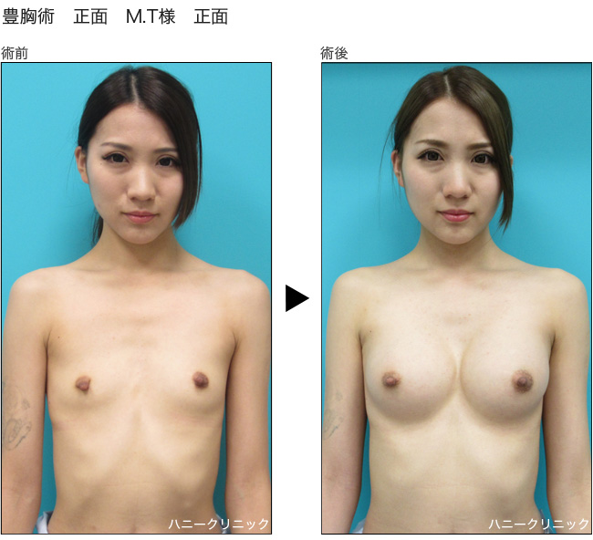 breast augmentation in sc topless teen pictorial