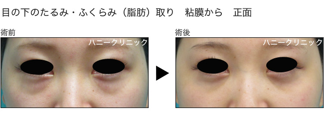 目の下のふくらみ取りなら熊本の美容外科へ