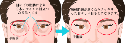 �ڂ̉��̂���ݎ�� �F�{