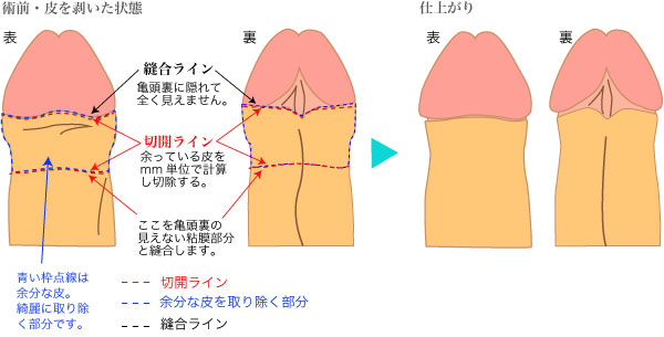 切れる 陰茎 皮膚