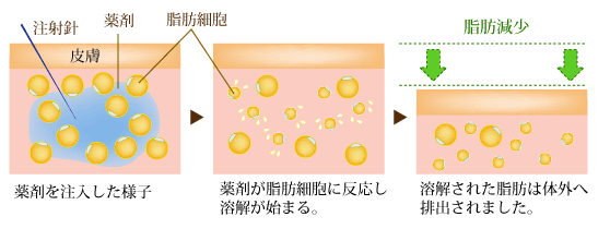 脂肪溶解注射／BNLS neo／Kabelline(カベリン)| 診療内容 | 熊本の美容