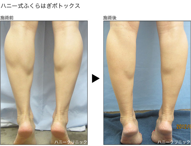 ふくらはぎボトックス ハニークリニック 熊本の美容外科