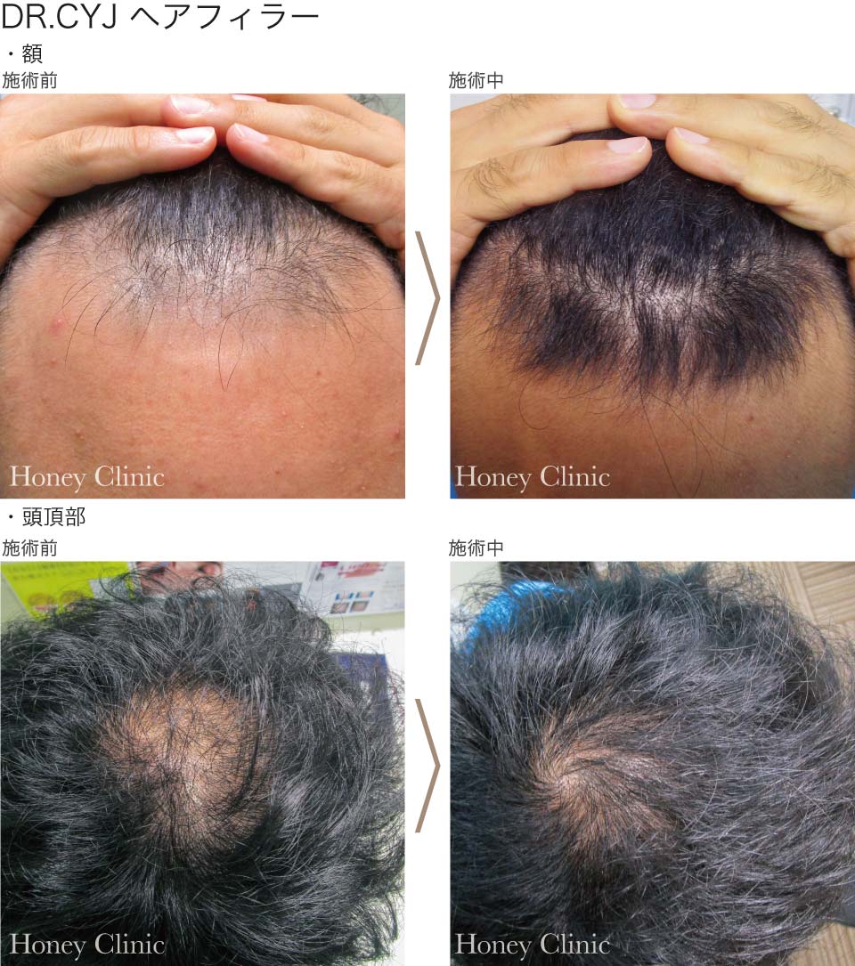 ヘアフィラーなら熊本の美容外科ハニークリニックへ