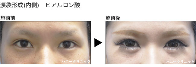 涙袋形成をするなら熊本の美容外科ハニークリニックへ