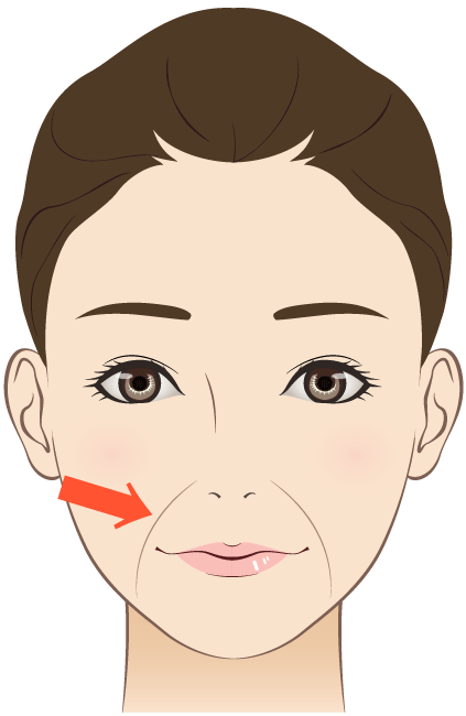 ほうれい線の治療は熊本の美容外科、ハニークリニックへ