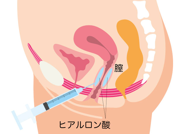 ヒアルロン酸注入による膣縮小 熊本