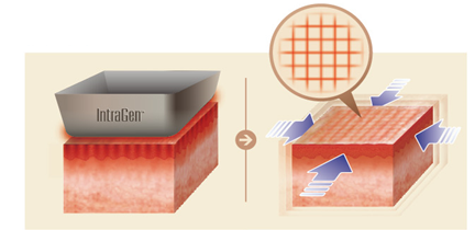 真皮リフト(イントラジェン)イメージ図