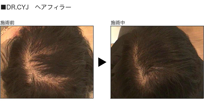 ヘアフィラー