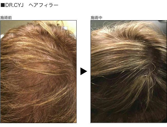 ヘアフィラー 熊本