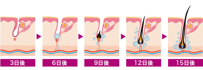 ヘアフィラー経過イラスト