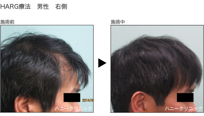 発毛治療 熊本