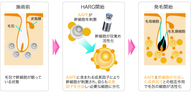 HARG(ハーグ)療法 熊本