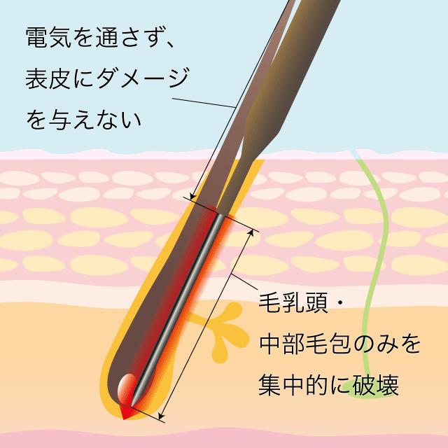 針脱毛時の皮膚の図