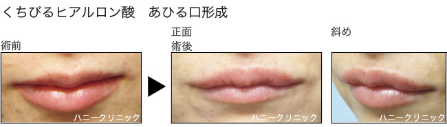唇形成をするなら熊本の美容外科ハニークリニックへ