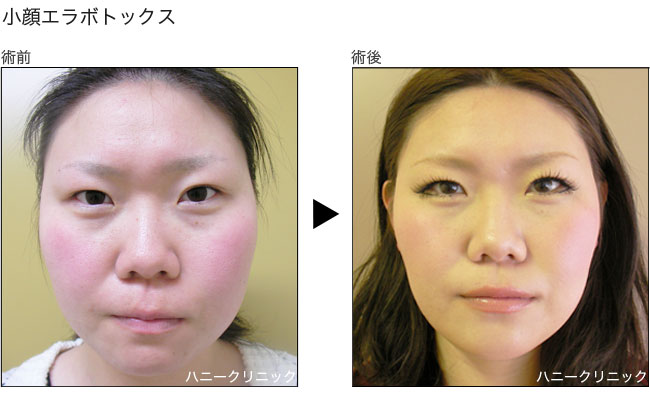 小顔ボトックスをするなら熊本の美容外科ハニークリニックへ