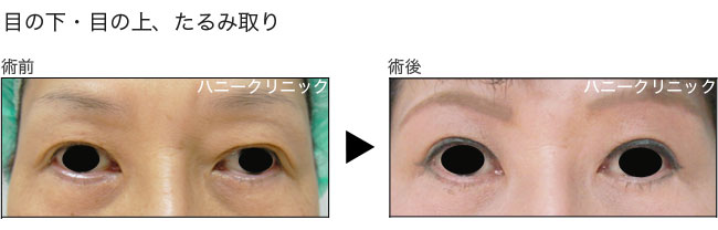 目の下のたるみ取り 熊本