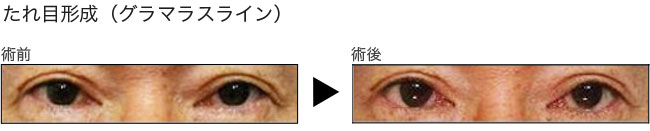 たれ目形成グラマラスラインをするなら熊本のハニークリニックへ