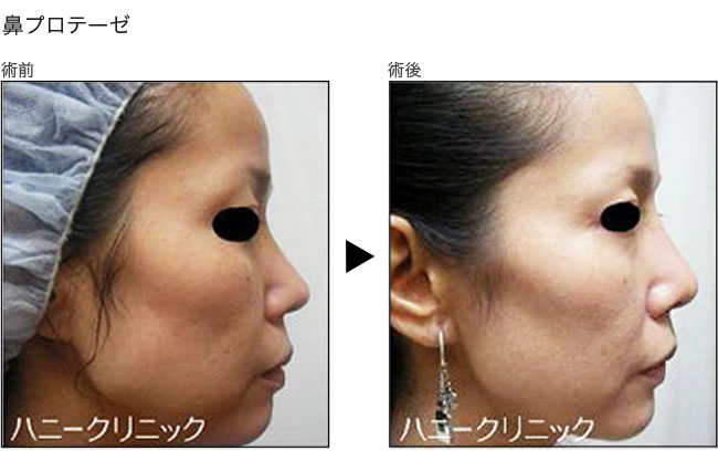 鼻の治療は熊本の美容外科ハニークリニックへ