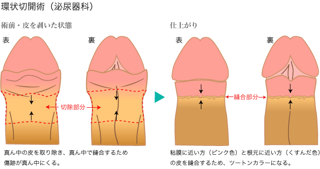 包茎 熊本