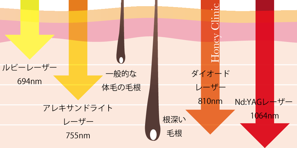 レーザーの種類の図