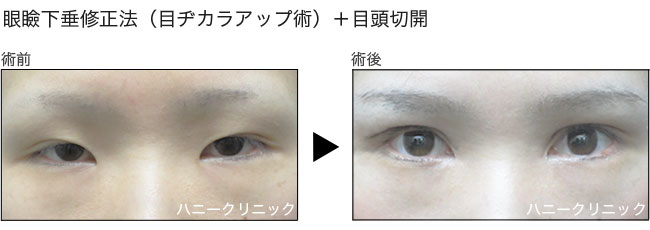 眼瞼下垂をするなら熊本の美容外科ハニークリニック