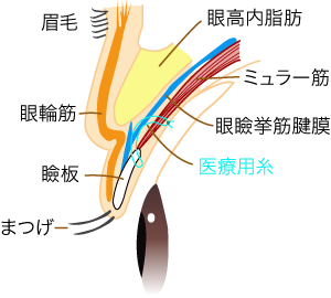 眼瞼下垂 熊本