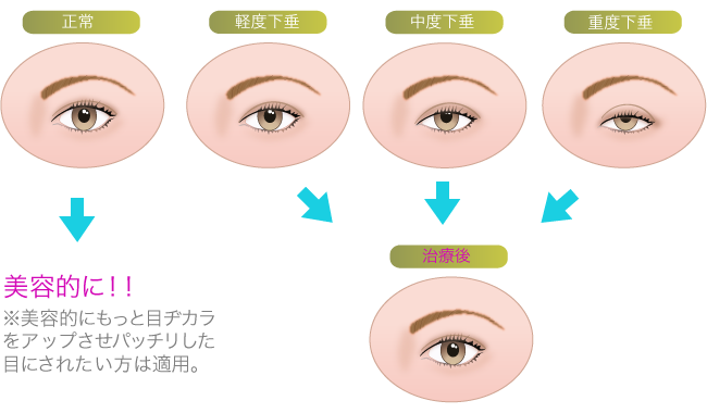 眼瞼下垂 熊本