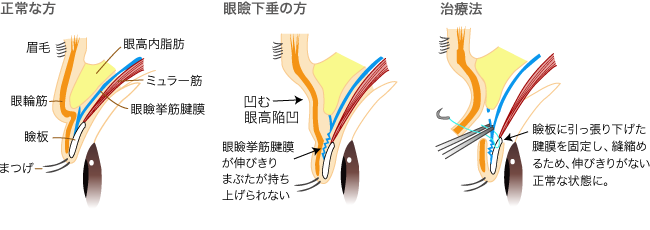 眼瞼下垂 熊本