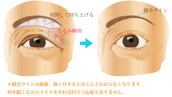 目の上のたるみ取り 熊本