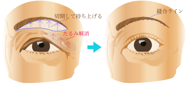 眉下切開法