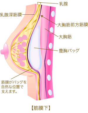 豊胸 熊本