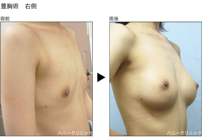 豊胸 熊本