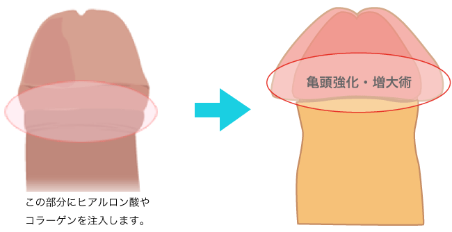 亀頭増大をするなら熊本の包茎手術専門医へ