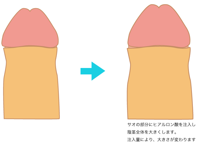 亀頭増大 強化術 陰茎増大 早漏治療 包茎 熊本の美容外科 ハニークリニック