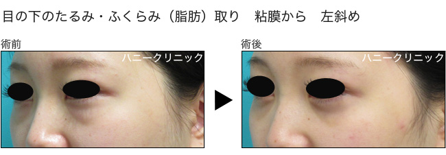 目の下のふくらみ取りをするなら熊本の美容外科へ