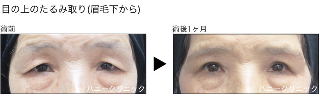 目の上のたるみ取りをするなら熊本の美容外科へ