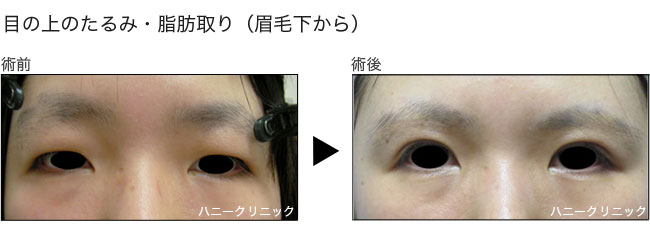 目の上のたるみ取りをするなら熊本の美容外科へ