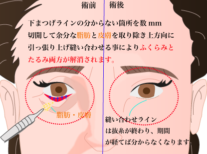 目の下の脂肪切除
