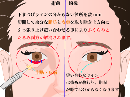 目の下のたるみ取り 熊本