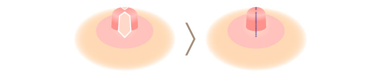 乳頭の太さ(直径)を小さくする施術