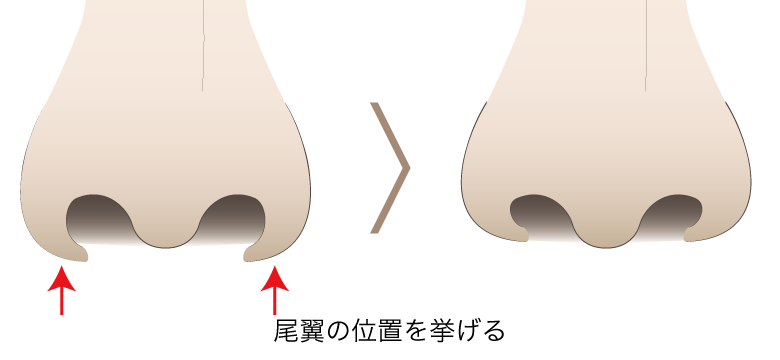 鼻翼基部挙上