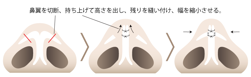 鼻翼軟骨3D形成術