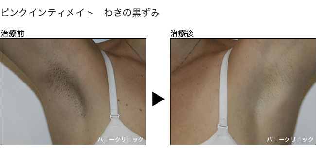 ピンクインティメイト治療なら熊本の美容外科ハニークリニックへ