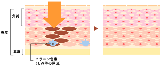 肌のしみ あざ 青黒い色素沈着 熊本